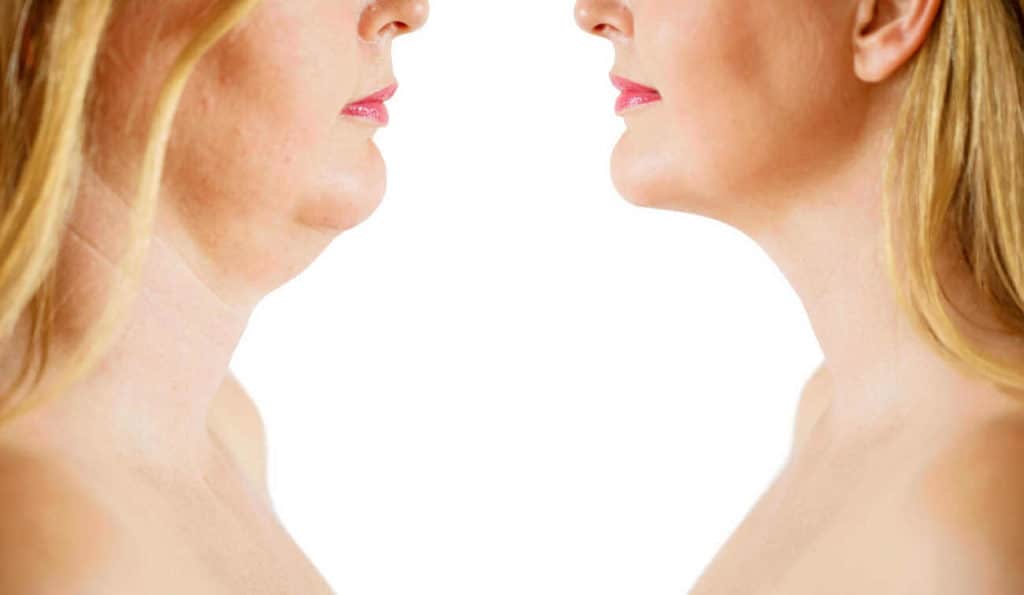 Double Chin treatment Rugby before and after results