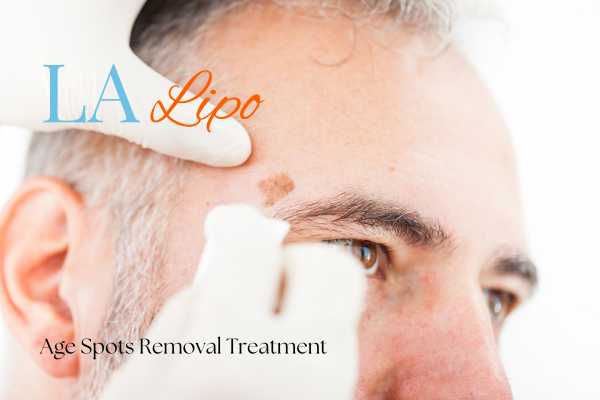 What Are the Most Effective Treatments for Age Spots Rugby?