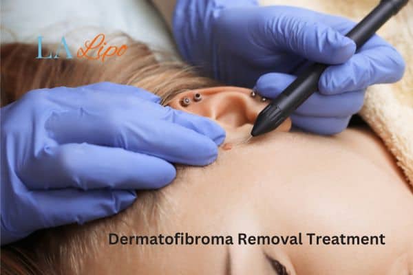 Dermatofibroma Removal Treatment Rugby