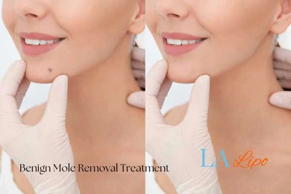 woman's before and after mole removal Rugby results