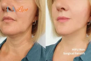 hi-fu for wrinkles Rugby before and after results