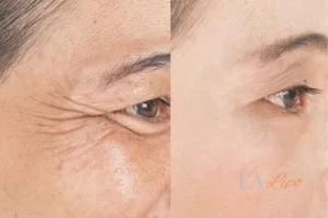 Before and after results of woman - HI-fu wrinkles reduction treatment Rugby
