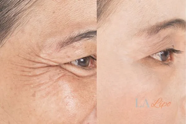 Before and after results of woman - HI-fu wrinkles reduction treatment Rugby