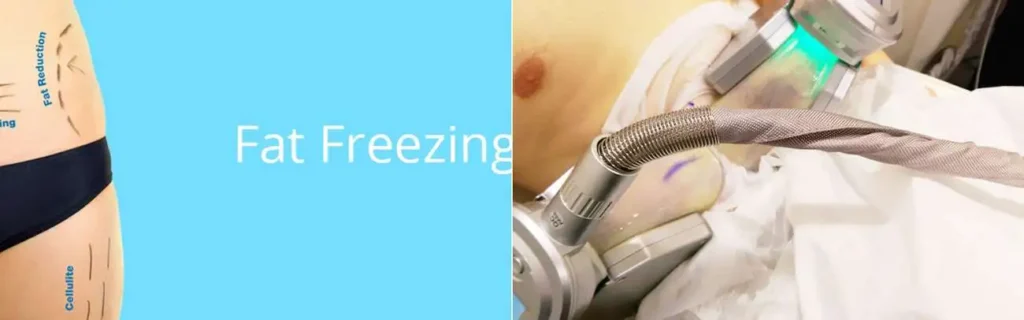Fat freezing Rugby on multiple areas of the body