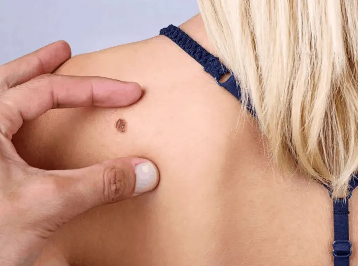 woman having mole removal Rugby consultation before treatment.