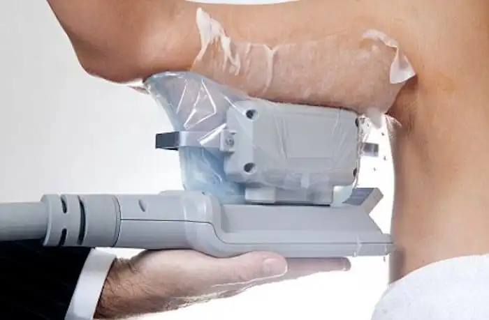 Picture of fat freezing Rugby on the upper arms.