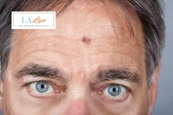Solar Lentigo Removal Rugby image of man with mark on his forehead