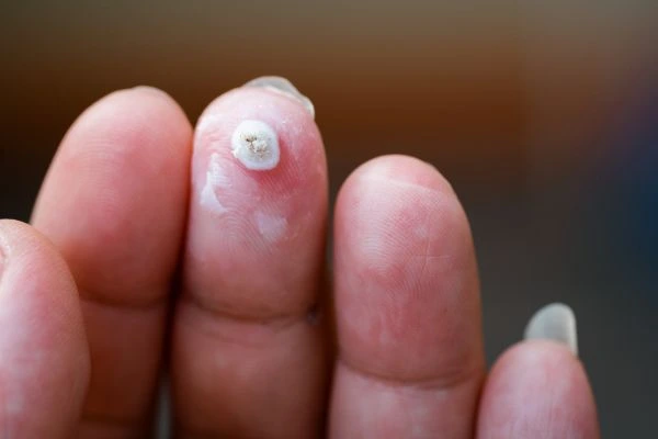 wart on person finger - cryotherapy to treat from LA LIPO Rugby