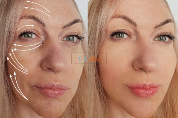 Morpheus 8 results Rugby face lift.