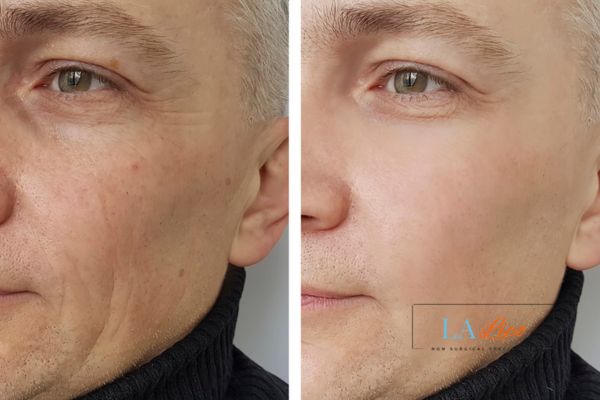 See the amazing results of Morpheus8 Treatment Rugby!