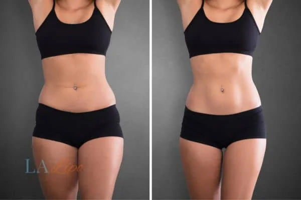 before and after results of non-surgical treatment to help a woman's body image and mental health Rugby