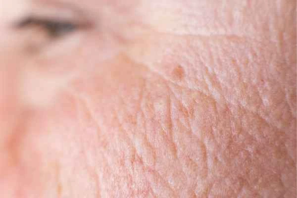 close up picture of a woman's face showing an age spot Rugby