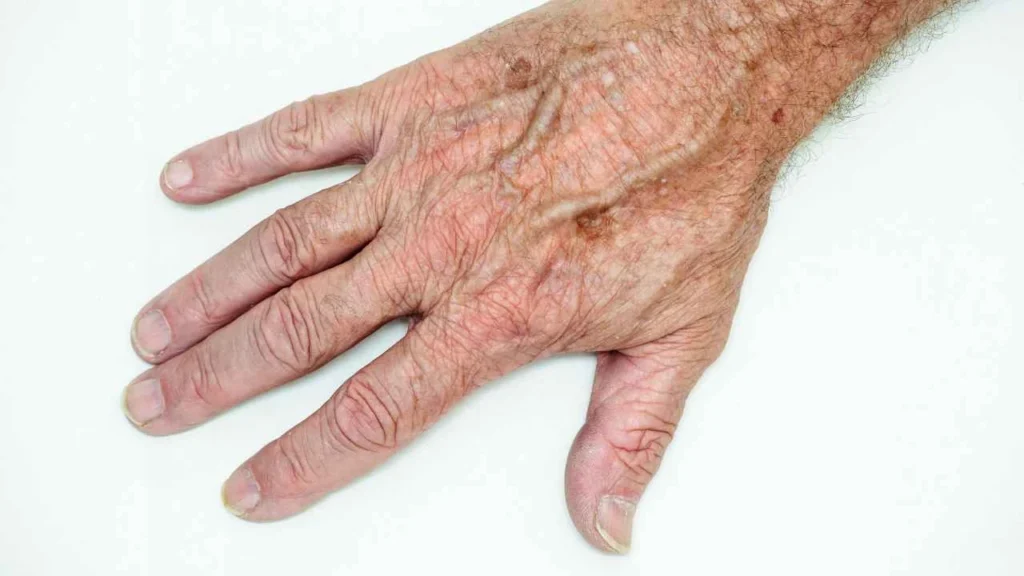 Male hand showing age spot Rugby