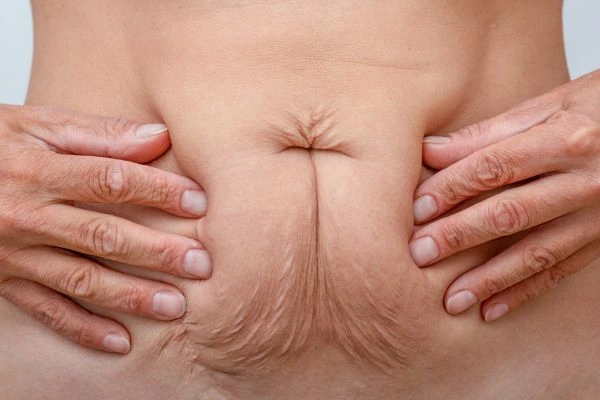 Should I Combine Diastasis Recti Treatment with Body Contouring for Better Results Rugby?