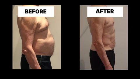 What Symptoms Can Diastasis Recti Cause in Men? Weak Core, Back Pain and Poor Posture Rugby
